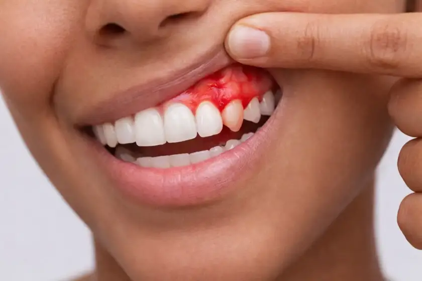 Sangrado de encías al cepillarme. Causas y cómo detenerlo.