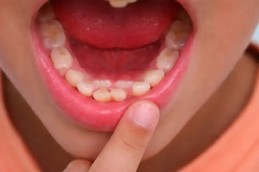 Dientes de tiburón en niños