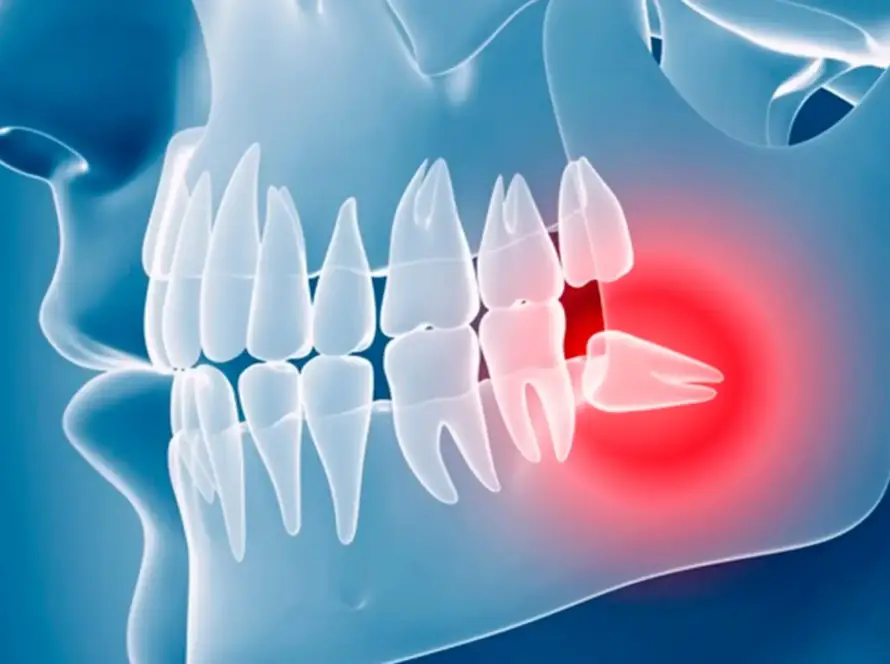 Gráfica muela juicio