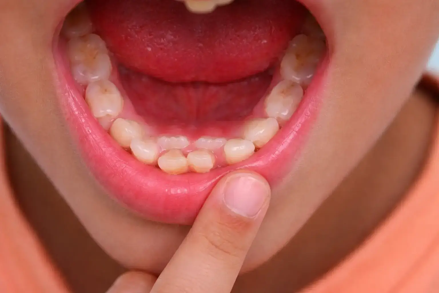 Dientes de tiburón en niños